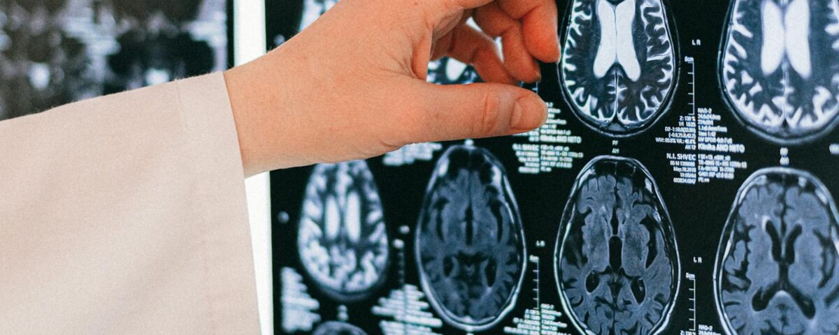 endothelial senescence Long COVID senolytics - zombie vasculature and vascular aging from viral infection