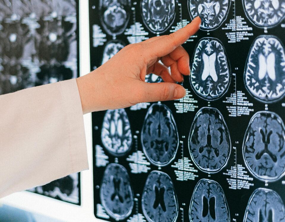 endothelial senescence Long COVID senolytics - zombie vasculature and vascular aging from viral infection