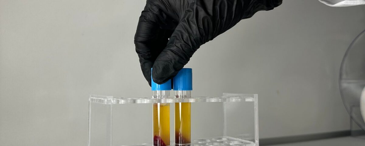 glycolytic trap - laboratory blood sample analysis illustrating post-viral metabolic testing
