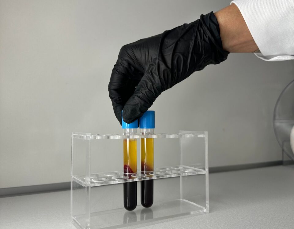 glycolytic trap - laboratory blood sample analysis illustrating post-viral metabolic testing